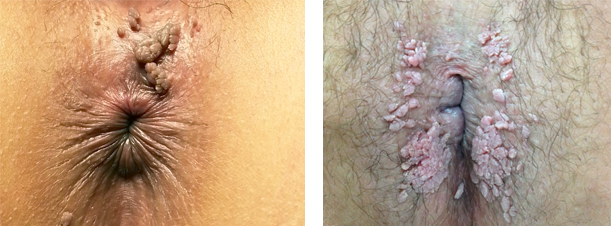 Genital Warts (HPV) Picture Image on MedicineNet.com